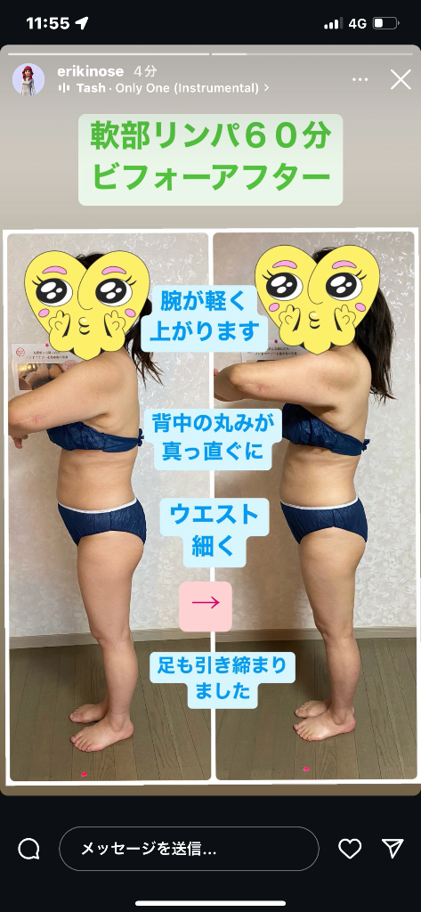 軟部リンパビフォーアフター