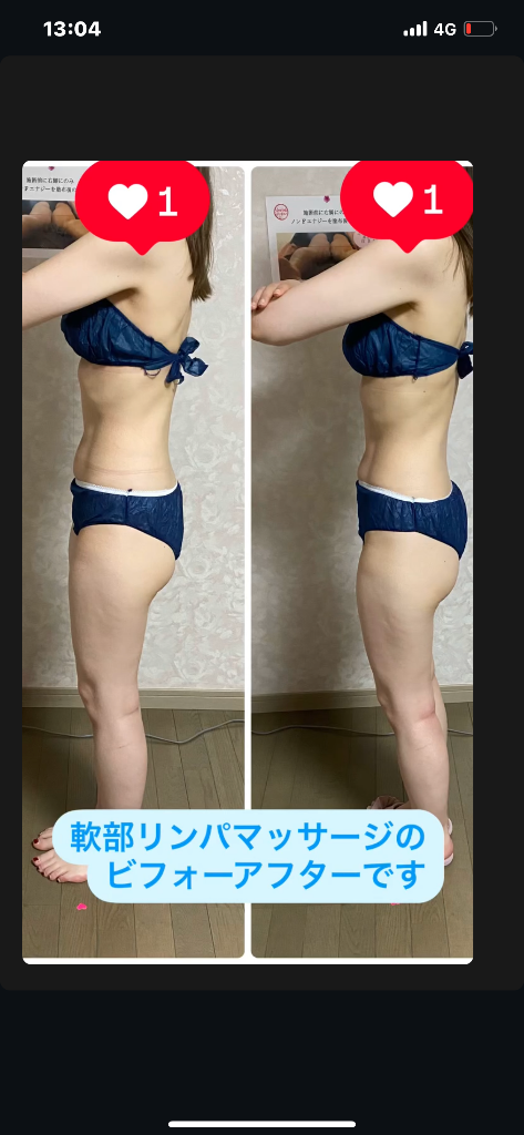 軟部リンパビフォーアフター