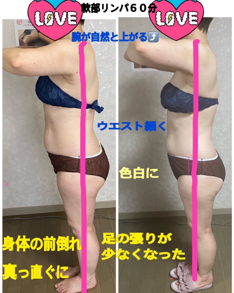 軟部リンパビフォーアフター