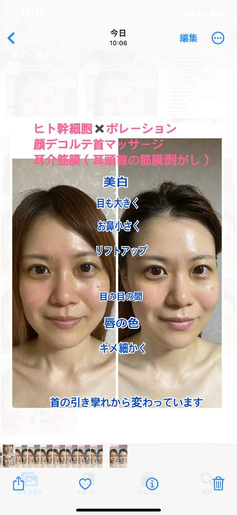 国産生ヒト幹細胞上澄み液✖️ポレーション　お顔デコルテ首マッサージ　耳介筋膜（耳　頭　首のマッサージ）ビフォーアフター